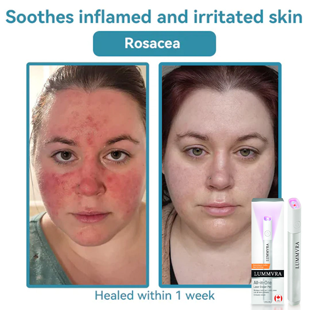 ✨ Lummvra™ All-in-One CO₂ Laser Eraser Pen | Removes Moles, Warts, Skin Flaws & Pigmentation