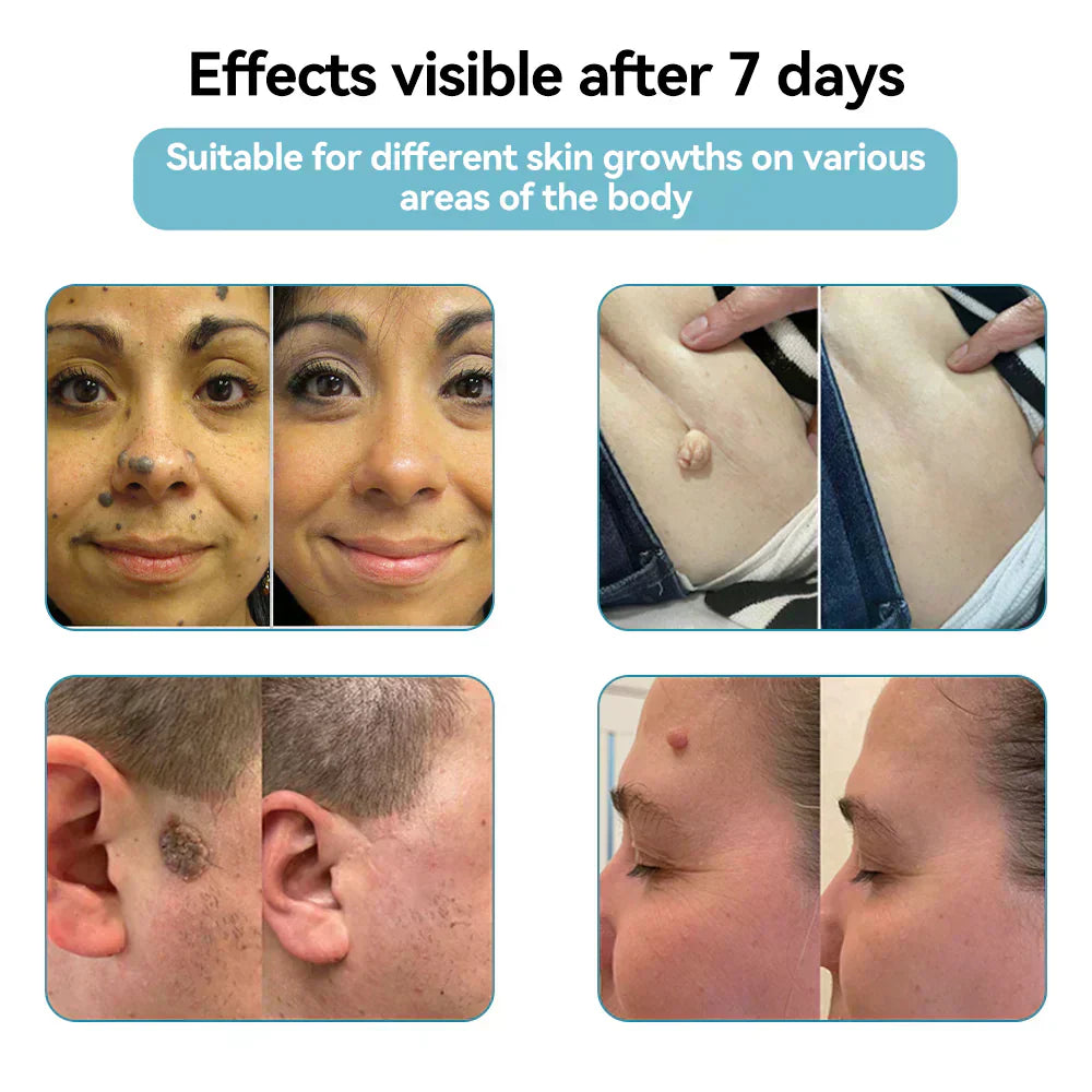 ✨ Lummvra™ All-in-One CO₂ Laser Eraser Pen | Removes Moles, Warts, Skin Flaws & Pigmentation