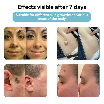 ✨ Lummvra™ All-in-One CO₂ Laser Eraser Pen | Removes Moles, Warts, Skin Flaws & Pigmentation