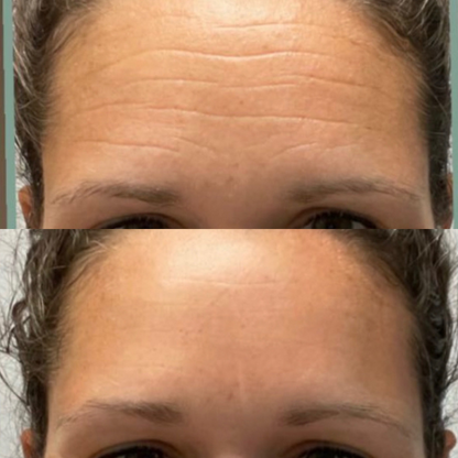 Lummvra® 10-in-1 Advanced Nano Microneedle Patches