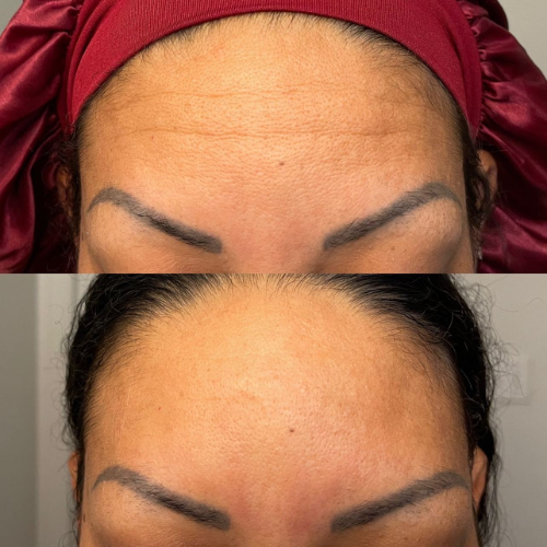 Lummvra® 10-in-1 Advanced Nano Microneedle Patches