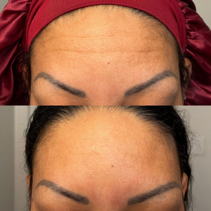 Lummvra® 10-in-1 Advanced Nano Microneedle Patches